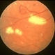 Retinal Capillary Hemangioma